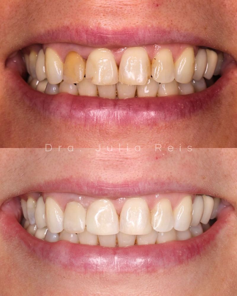 Antes e depois de tratamento de dentística estética realizado pela Dra. Júlia Reis, em Santana, São Paulo