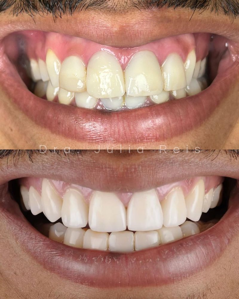 Antes e depois de tratamento de dentística estética realizado pela Dra. Júlia Reis, em Santana, São Paulo