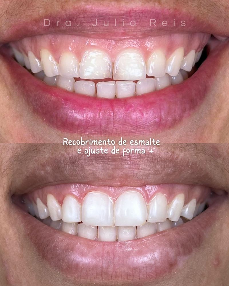 Antes e depois de recobrimento de esmalte e ajuste de forma realizado pela Dra. Júlia Reis, em Santana, São Paulo